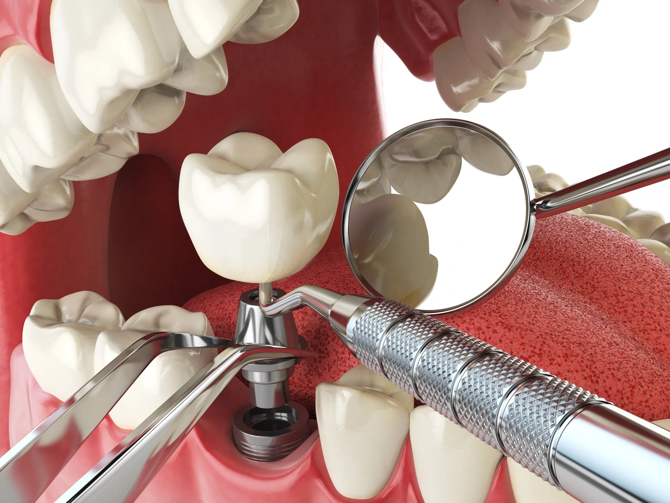 dental implants in Pearland, TX
