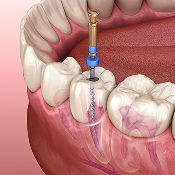 3 Stages of Root Canal Treatment