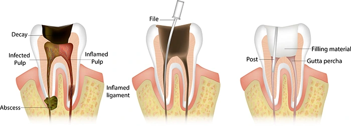 Failed Root Canal?
