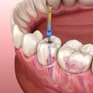 How Root Canal Treatment Work