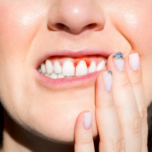 Can Orthodontics cause Gum Recession?