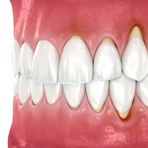 How does orthodontics cause Gum recession